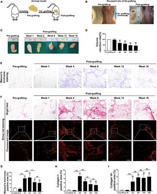 Necroptosis in Macrophage Foam Cells Promotes Fat Graft Fibrosis in Mice